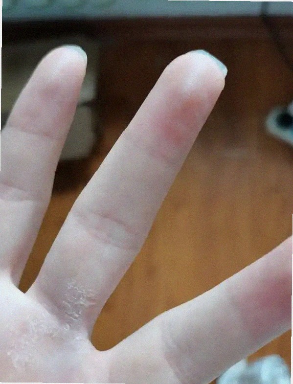문제성발톱 약 괜찮을까요