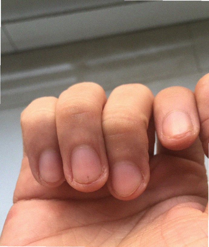 손가락무좀 이거 맞나요