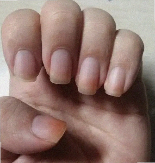 엄지 손톱 검은세로줄 어쩌죠