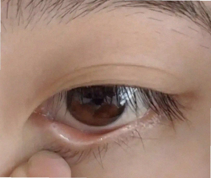 마이봄샘 염증 이상한데 왜 그럴까요