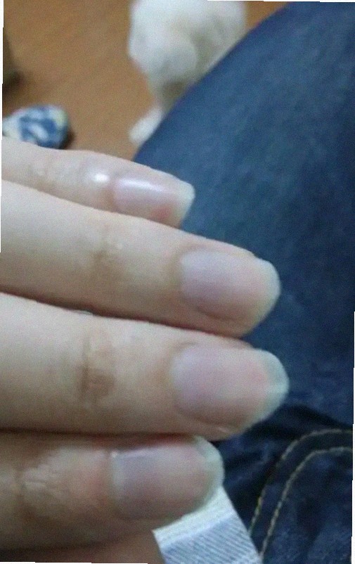 손톱 눌림 이거 뭘까요