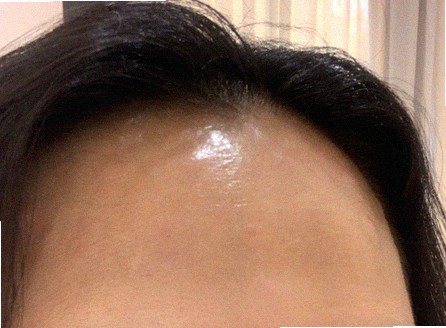얼굴 실리프팅 처음 받는데 괜찮을까요?