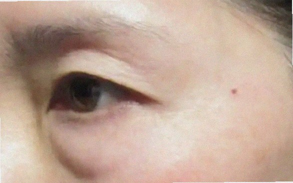 포텐자 붉은기 얼마나 지속되나요