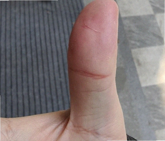아기발물집 어떡하죠