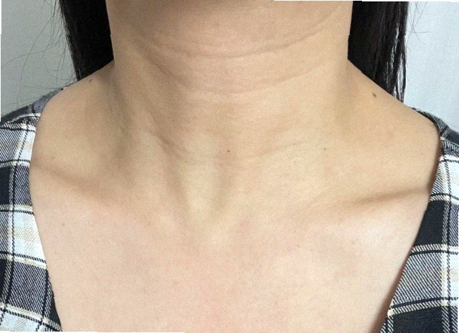 실리프팅후붓기 얼마나 지속되나요