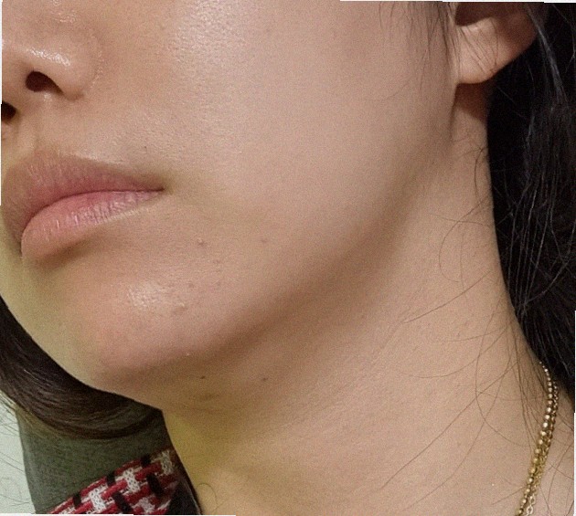 실리프팅 유지기간 얼마나 되나요