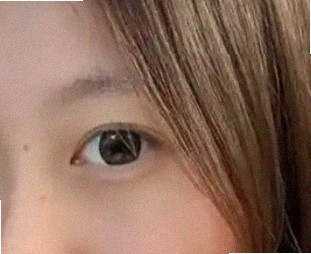 비염눈가려움 때문에 힘든데요