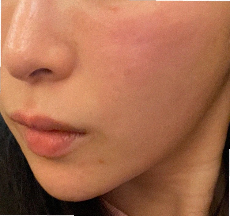 실리프팅 유지기간 얼마나 되나요