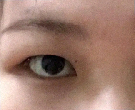 눈꺼풀 처짐 나이때문인 것 같아요