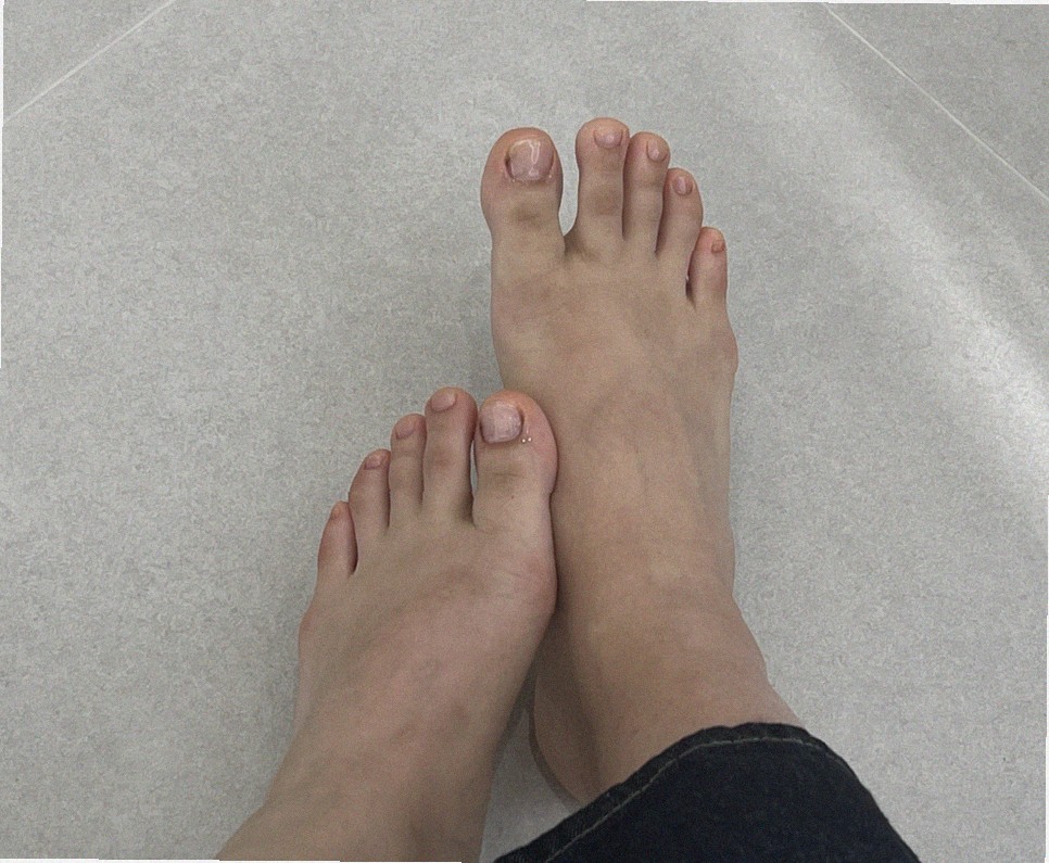 강력한 무좀약 추천좀요
