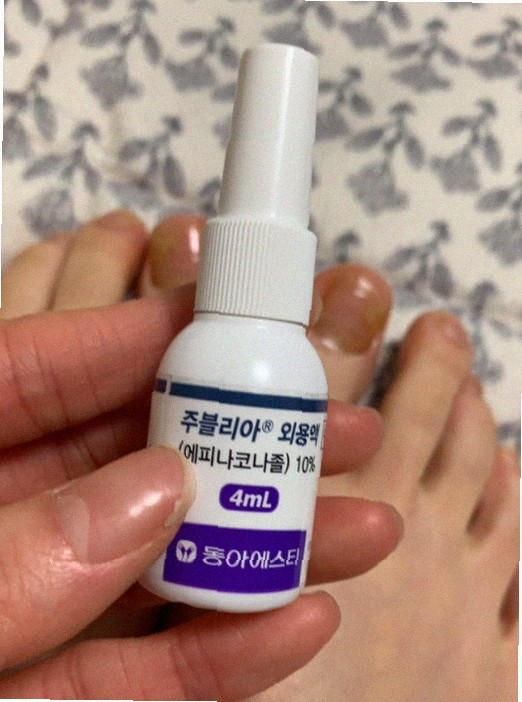 손톱무좀 증상 맞나요